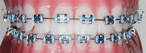 Orthodontic Metal Brackets 